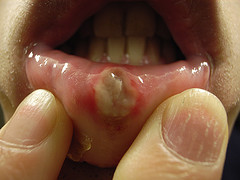 canker sore home remedy picture