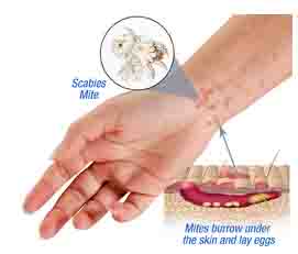 scabies on arm - example 1 - 271px x 231px